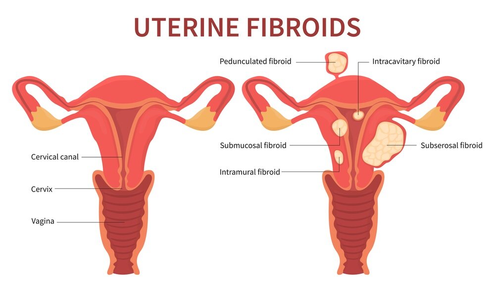 Understanding Uterine Fibroids: Causes, Symptoms, and Treatment Options
